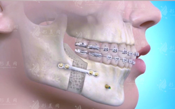 成都颏成型手术医生推荐：这三位李姓医生技术绝了!