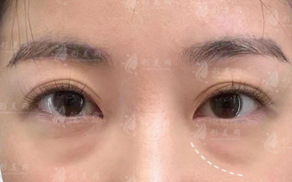 去眼袋580元靠谱吗?低价眼袋手术真相揭秘