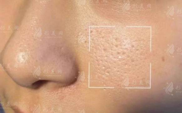 广州黄金微针多少钱?四代价格3000-6000元全揭秘