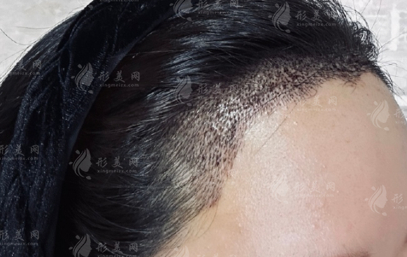 济南海峡植发医院怎么样?技术实力医生大揭秘!