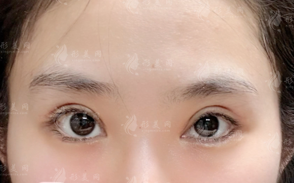 武汉王海平和项利姣眼修复哪家好?技术优势对比