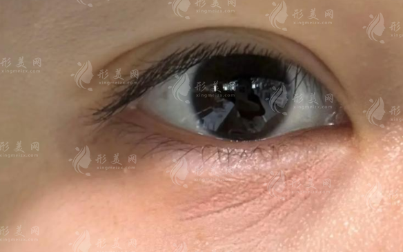 眼周注射胶原蛋白去细纹靠谱吗?效果真相大揭秘