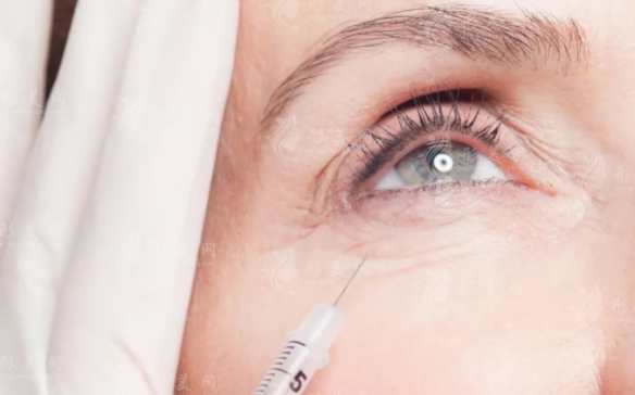 眼周注射胶原蛋白去细纹靠谱吗？效果真相大揭秘