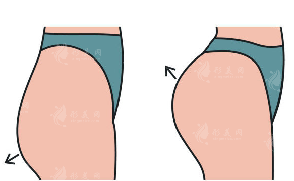 自体脂肪填充胸部臀部能一起做吗？专家详解