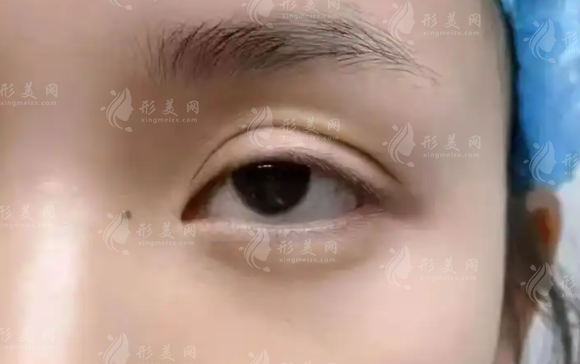 北京张冰洁眼修复口碑怎么样?20年经验+解剖复位技术解析