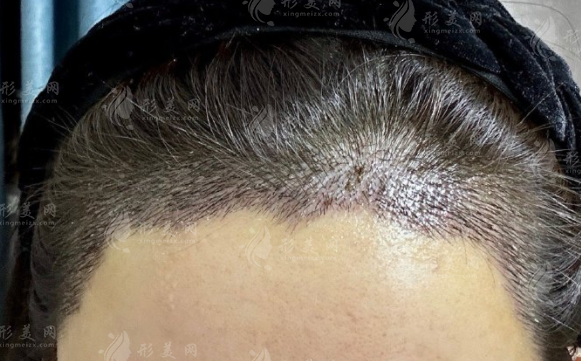成都大麦微针植发医院:微针植发与FGF双活因子技术深度解读 成都大麦微针植发医院:微针植发与FGF双活因子技术深度解读