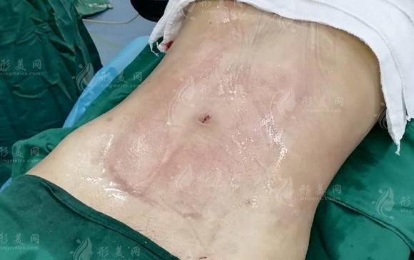 2026成都吸脂医院推荐!性价比高还不贵，价格表一览