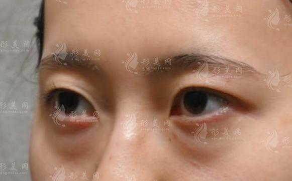 580元改善眼袋靠谱吗?揭秘低价去眼袋的隐藏真相