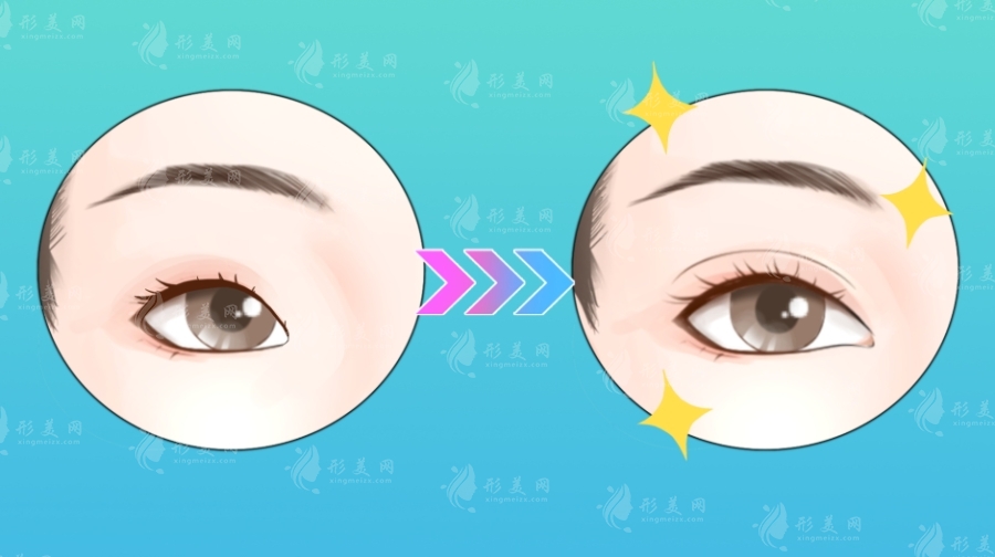 上海张楚双眼皮修复好吗?20年经验价格技术全解析 上海张楚双眼皮修复好吗?20年经验价格技术全解析