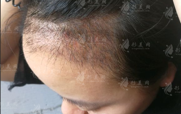 济南植发医院哪家好？海峡植发口碑实力揭秘