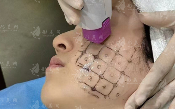 苏州热玛吉价格表2026：第四代全脸600发7800元起值得做吗?