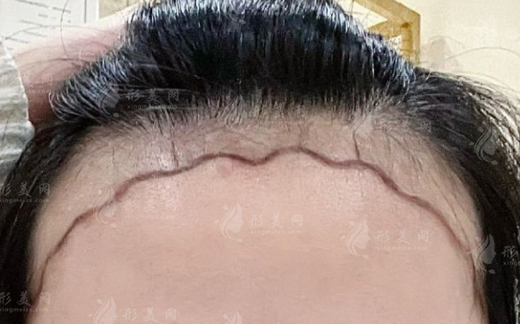 天津植发医院哪家好?熙朵植发上榜前三技术价格全解析