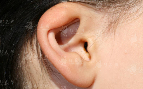 郑州张正文耳再造技术怎么样?5万起重塑逼真耳朵，效果揭秘!