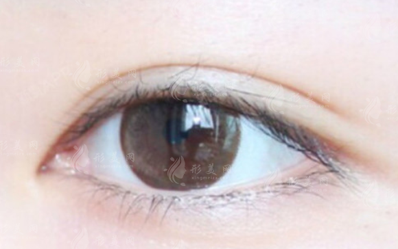 2026郑州双眼皮医生排名前十!选对人不踩坑