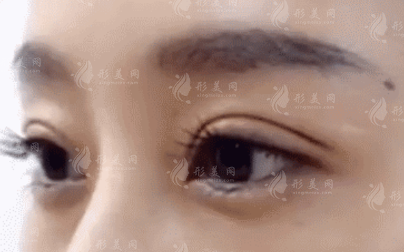 魏志香双眼皮修复怎么样?北京眼修复名医技术解析