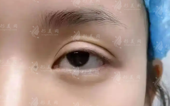 郑小红眼修复1.3万起贵吗?看完技术细节再判断!