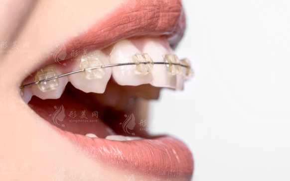 北京诺美口腔2026收费价目表曝光！6店通用/种植牙4988起/矫正8800起