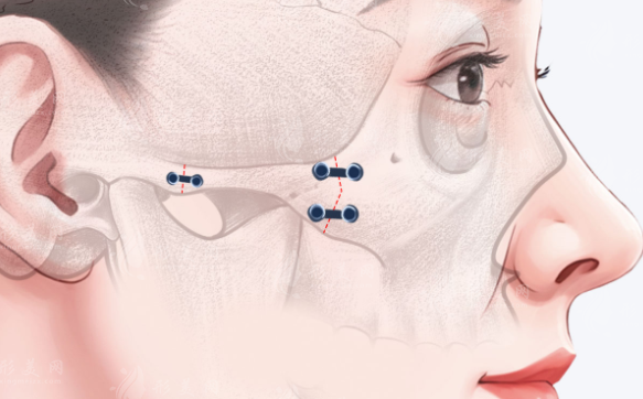 北京改脸型医生黄大勇技术如何?下颌角颧骨内推全解析!