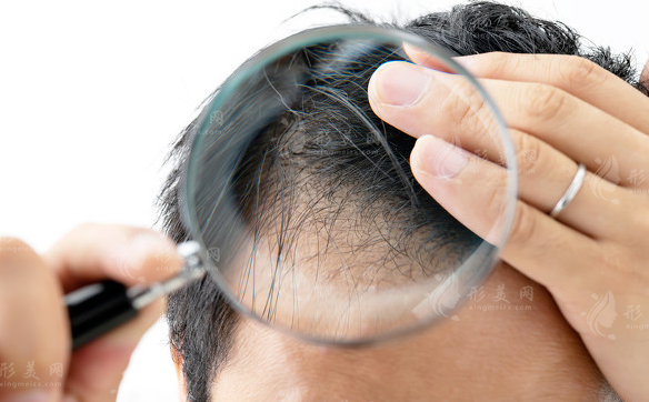 北京中德植发怎么样?徐霞博士团队3大优势揭秘，发友真实评价曝光