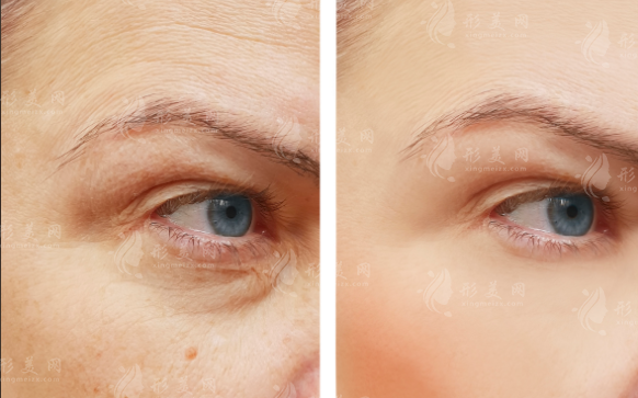 成都张志兵无痕去眼袋多少钱?9180元起技术解析