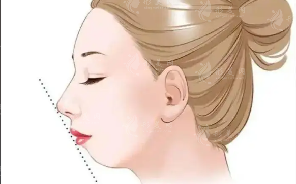 颏成型vs假体垫下巴哪个好？5大核心区别全解析