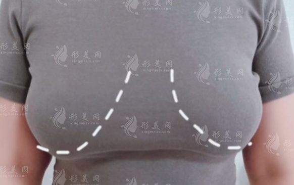 李建东维维胸下垂提升靠谱吗？真实技术揭秘