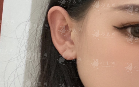 埋线精灵耳能维持多久？揭秘真实保持时间