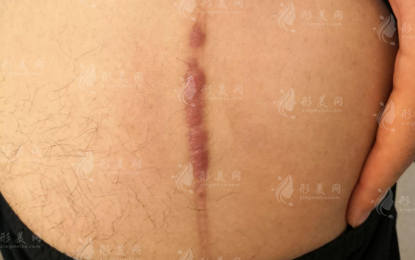 于艳菊治疤痕效果好吗?专业解读来了