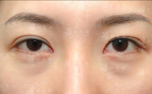 郑州健丽医美不开刀祛眼袋，微创无痕告别眼袋烦恼