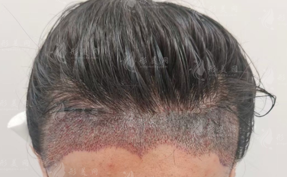 2026碧莲盛植发收费标准 各部位植发价格全解析