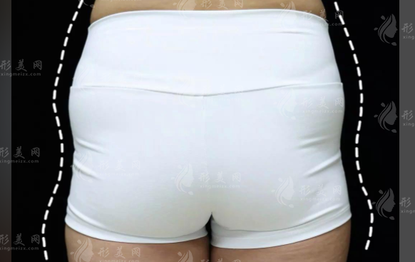 沈阳妈妈臀吸脂哪家好?这5家医院技术口碑实测对比