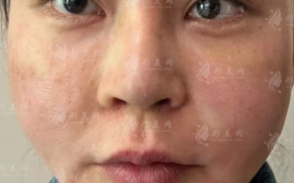 北京俊泰美好馒化脸修复好吗 技术靠谱口碑佳当天见效果