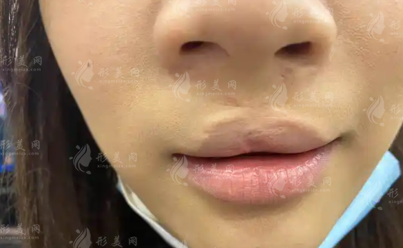 2026上海唇裂修复哪家好?伯思立、华美、海华三大名医实力PK