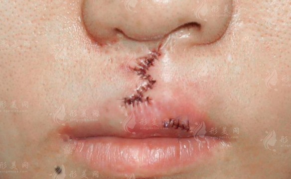 唇腭裂手术国家补贴怎么领？2026新政策+申请攻略+报销比例一览