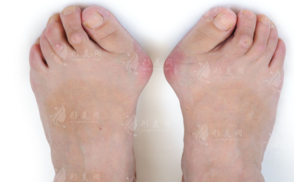 大脚骨微创手术哪家医院好？全国拇外翻正规医院排名前十公布