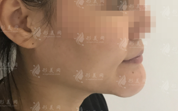 广州漫一凡医生取生长因子靠谱吗？4K内窥镜精准取出技术解析