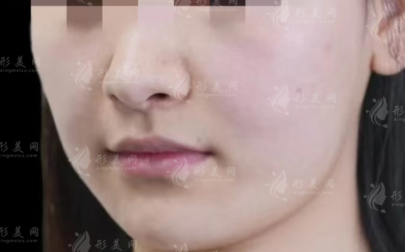 英伦大提升抗衰效果好吗？分层紧致+长效维持2-3年实测