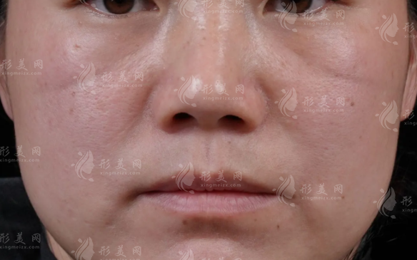 印第安纹怎么去除？分清类型选对医美方案不花冤枉钱