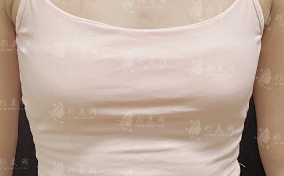 美波婷械三胶原丰胸靠谱吗?核心材料来源与安全性解析