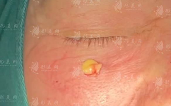 生长因子取出多少钱?2026国内5强医院排名：技术医生费用全攻略