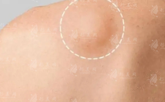 上海脂肪结节修复哪家好?谢卫国卢九宁蹇洪技术口碑全解析