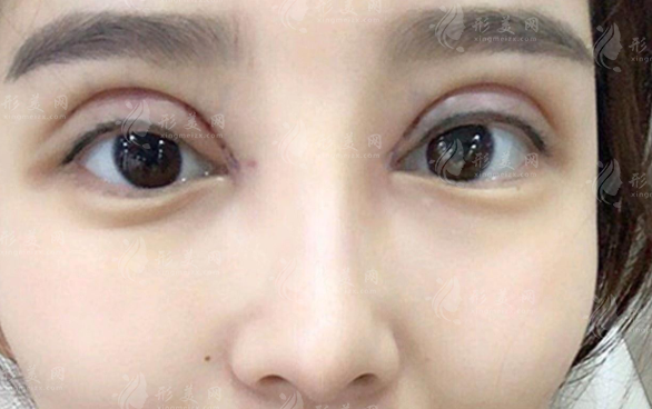 双眼皮修复医生排名前十：国内眼修复口碑专家技术解析