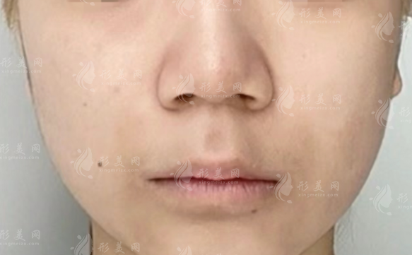 文丰做鼻子2.8万起，仿生支架+毫米剥离，10年满意度超90%