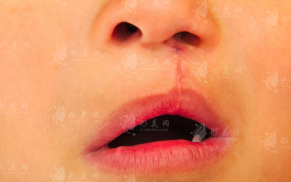 赵久丽唇裂修复8000元起，成都二院坐诊，20年经验技术强