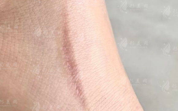 贵阳华医疤痕科2026价目表：刘青/刘晓芳/党永明医生收费曝光