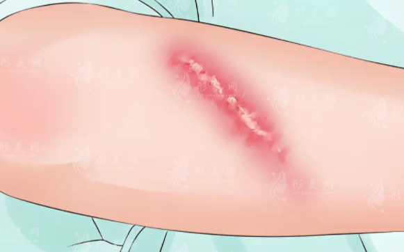 疤痕疙瘩切了又长?SRT-100照4次告别复发