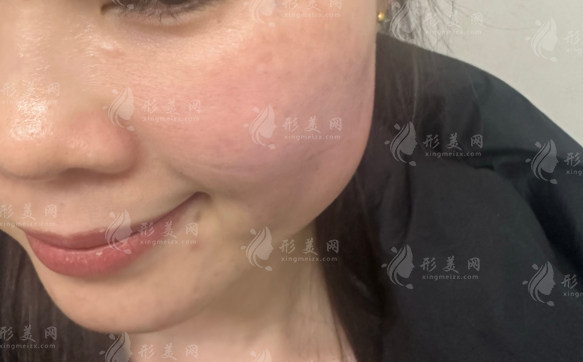 北京黎星医生20年专攻修复，生长因子取出微创无痕