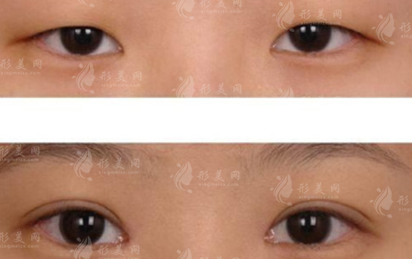 北京美莱上睑下垂矫正好吗?技术+价格全解析