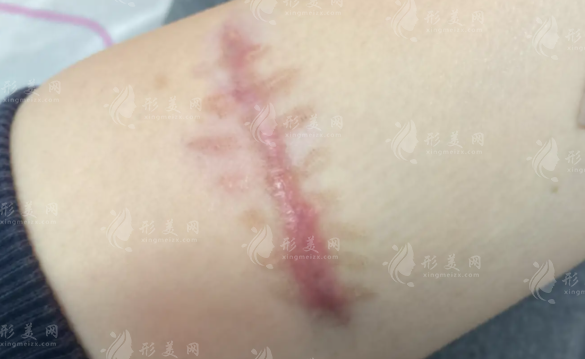 成都祛疤医院哪家强?军建、八大处等6家正规机构实力对比