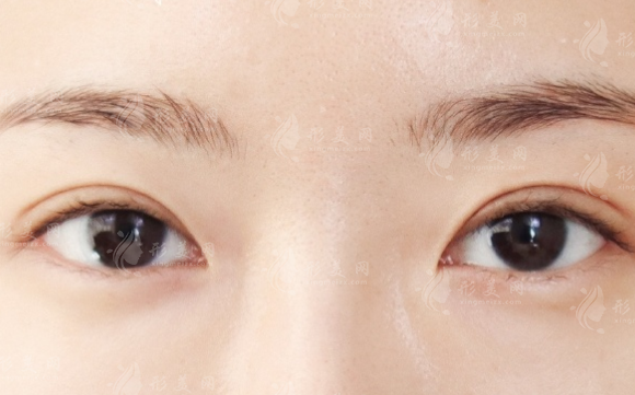 崔利杰做双眼皮口碑如何?技术特色与价格详解